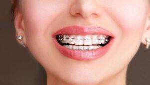 Read more about the article Cost Of Damon Braces in Bangalore
