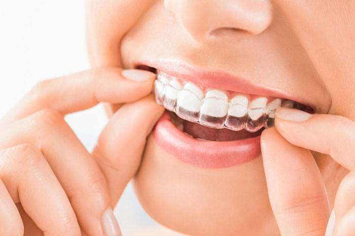 Read more about the article Invisalign Dentist in Bangalore