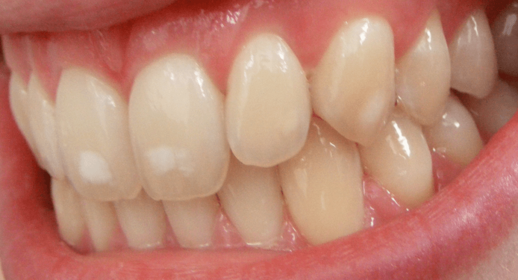 You are currently viewing FLUOROSIS TREATMENT IN BANGALORE