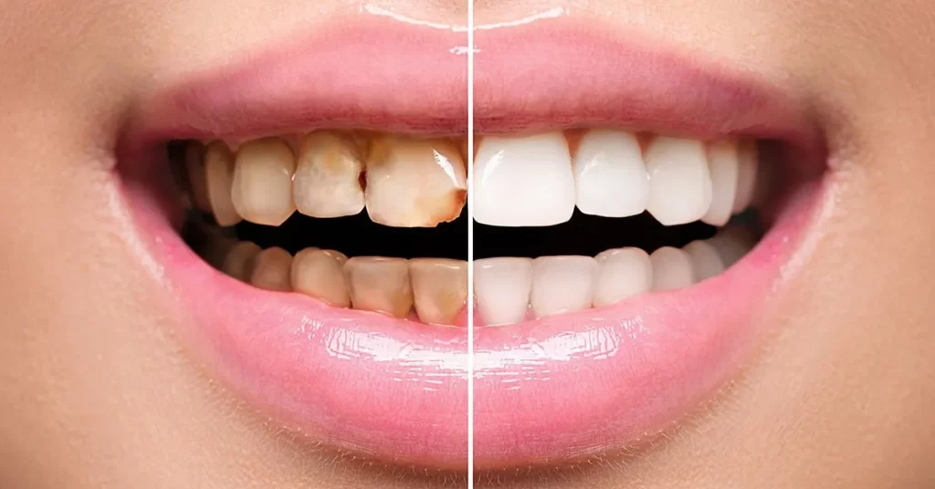 You are currently viewing Are veneer Teeth Permanent