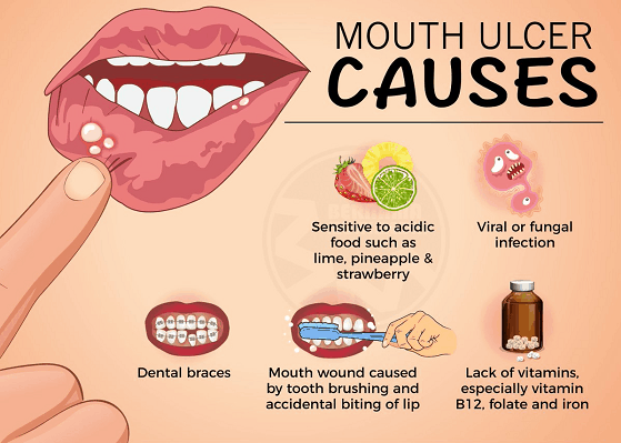 What Causes Mouth Ulcers And Its Treatment Amaya Dental Clinic