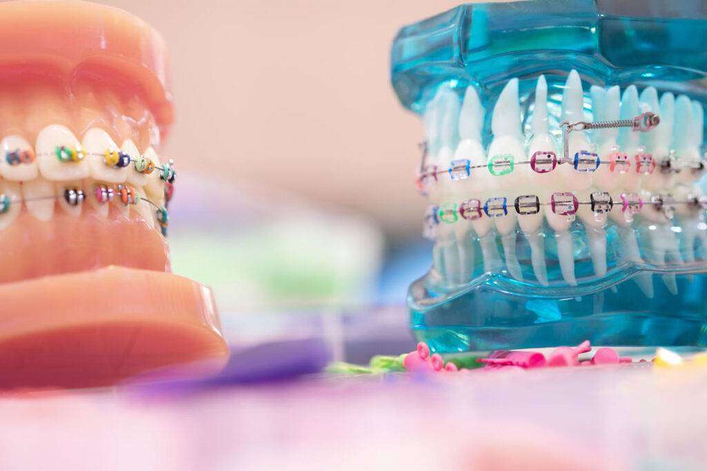 You are currently viewing ORTHODONTIC TREATMENT BRACES