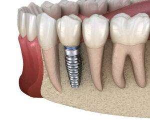 Read more about the article Dental Implants in Bangalore