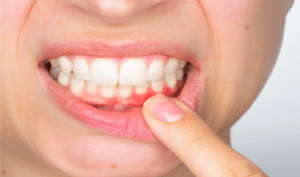 Read more about the article How is gum disease treated and prevented?