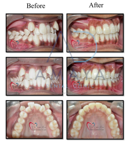 7 Rules About tooth prosthesis Meant To Be Broken