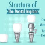 How All-on-4 Dental Implants Revolutionize Full Mouth Restoration