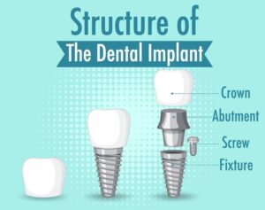 Read more about the article How All-on-4 Dental Implants Revolutionize Full Mouth Restoration