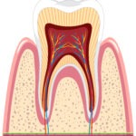 Painless root canal with lasers at  best dental clinic India