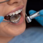 All About Dental Bonding – Best Smile Makeover in Bangalore