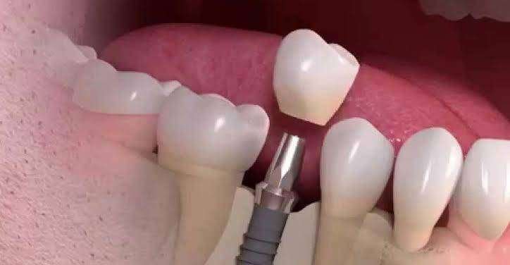 Dental Implants in Bangalore