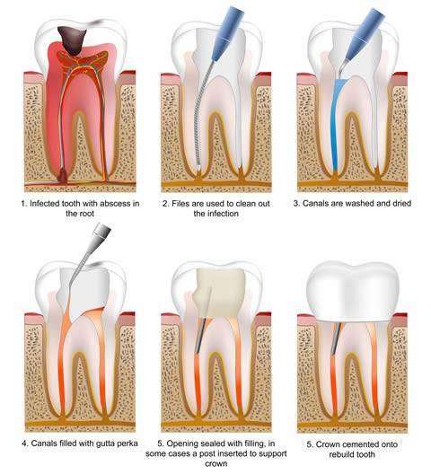 Root Canal Treatment in Bangalore