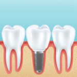 Dental Implants Cost in Bengaluru & What to Expect