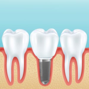 Read more about the article Dental Implants Cost in Bengaluru & What to Expect