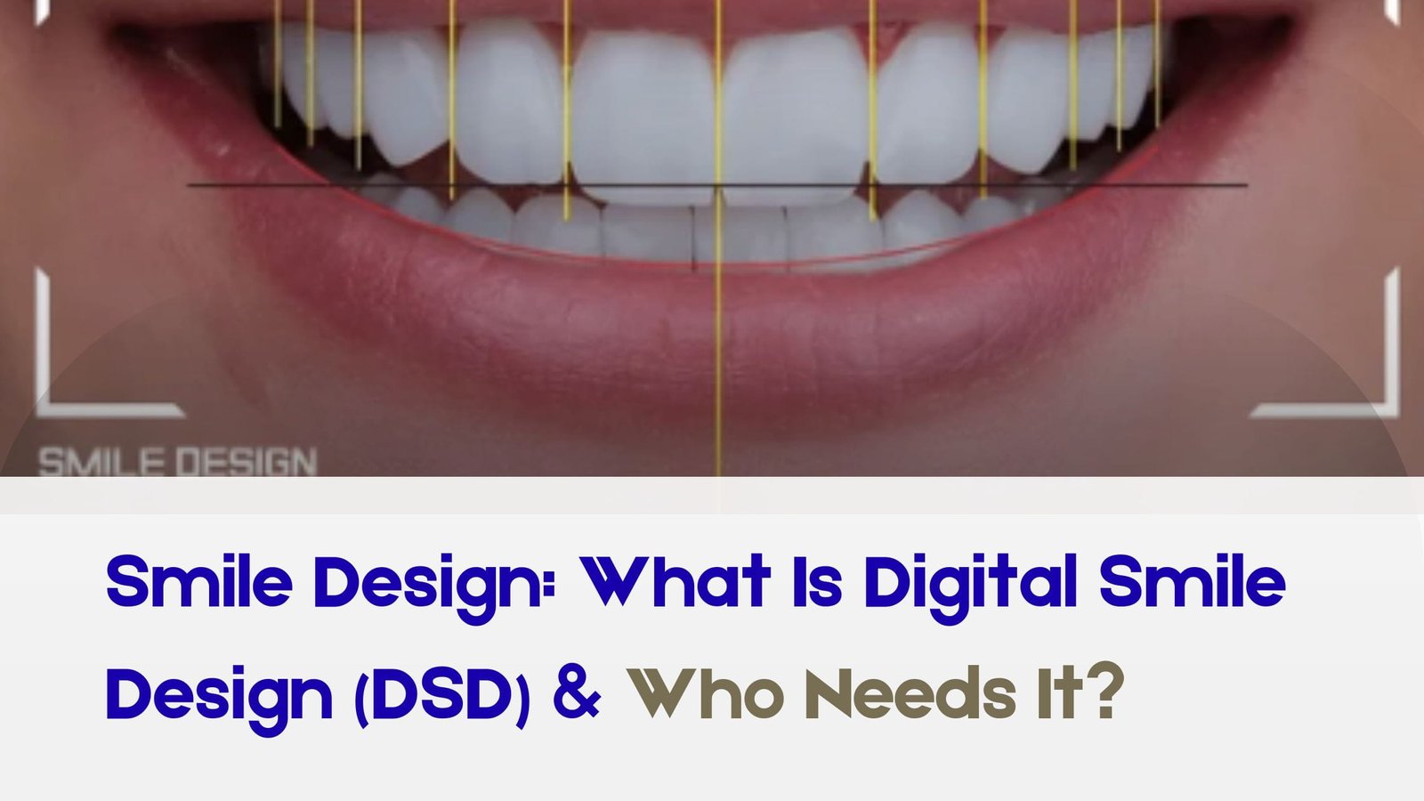 Read more about the article Smile Design: What Is Digital Smile Design (DSD) & Who Needs It?