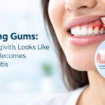 Bleeding Gums: What Gingivitis Looks Like Before It Becomes Periodontitis
