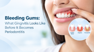 Bleeding Gums: What Gingivitis Looks Like Before It Becomes Periodontitis
