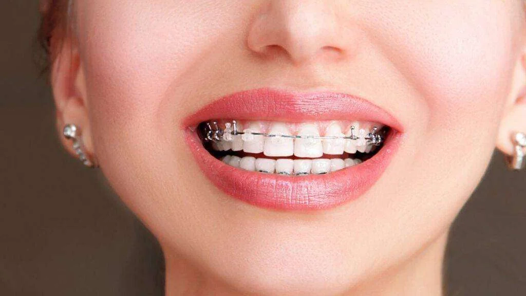 You are currently viewing Cost Of Damon Braces in Bangalore