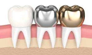Read more about the article Zirconia cap cost in bangalore