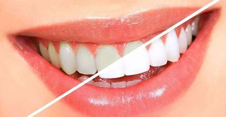 best teeth whitening in Bangalore