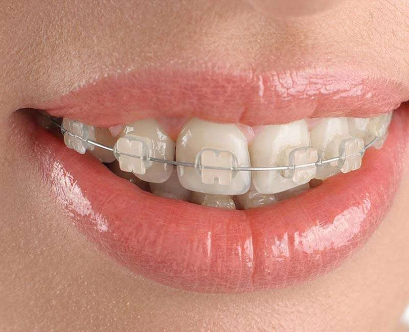 You are currently viewing Ceramic Braces in Bangalore