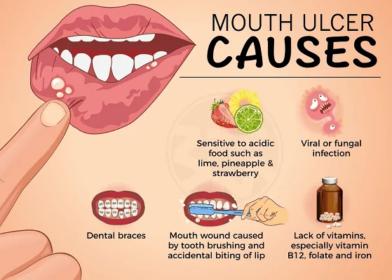 You are currently viewing What causes mouth ulcers and its treatment