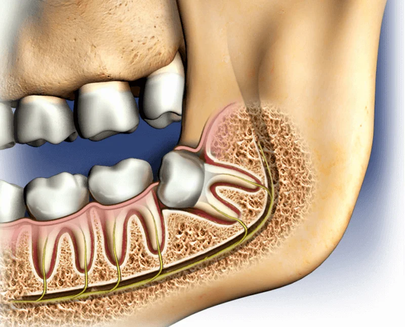 You are currently viewing Wisdom tooth extraction in bangalore