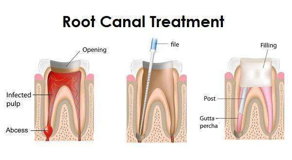 Read more about the article Root Canal Charges Bangalore