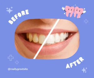 Read more about the article Teeth Stain Removal in Bangalore