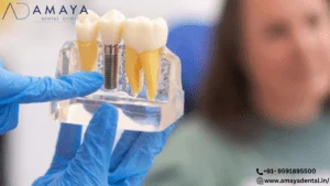 Read more about the article Ready to say goodbye to gaps in your teeth?  Dental bonding is the remedy you’ve been searching for!