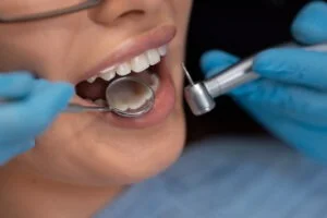 Read more about the article All About Dental Bonding – Best Smile Makeover in Bangalore
