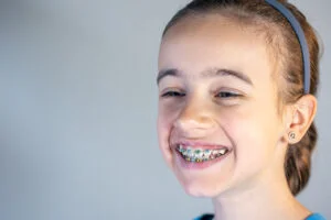Read more about the article Invisible Braces in Bangalore – The Best Choice for a Confident Smile