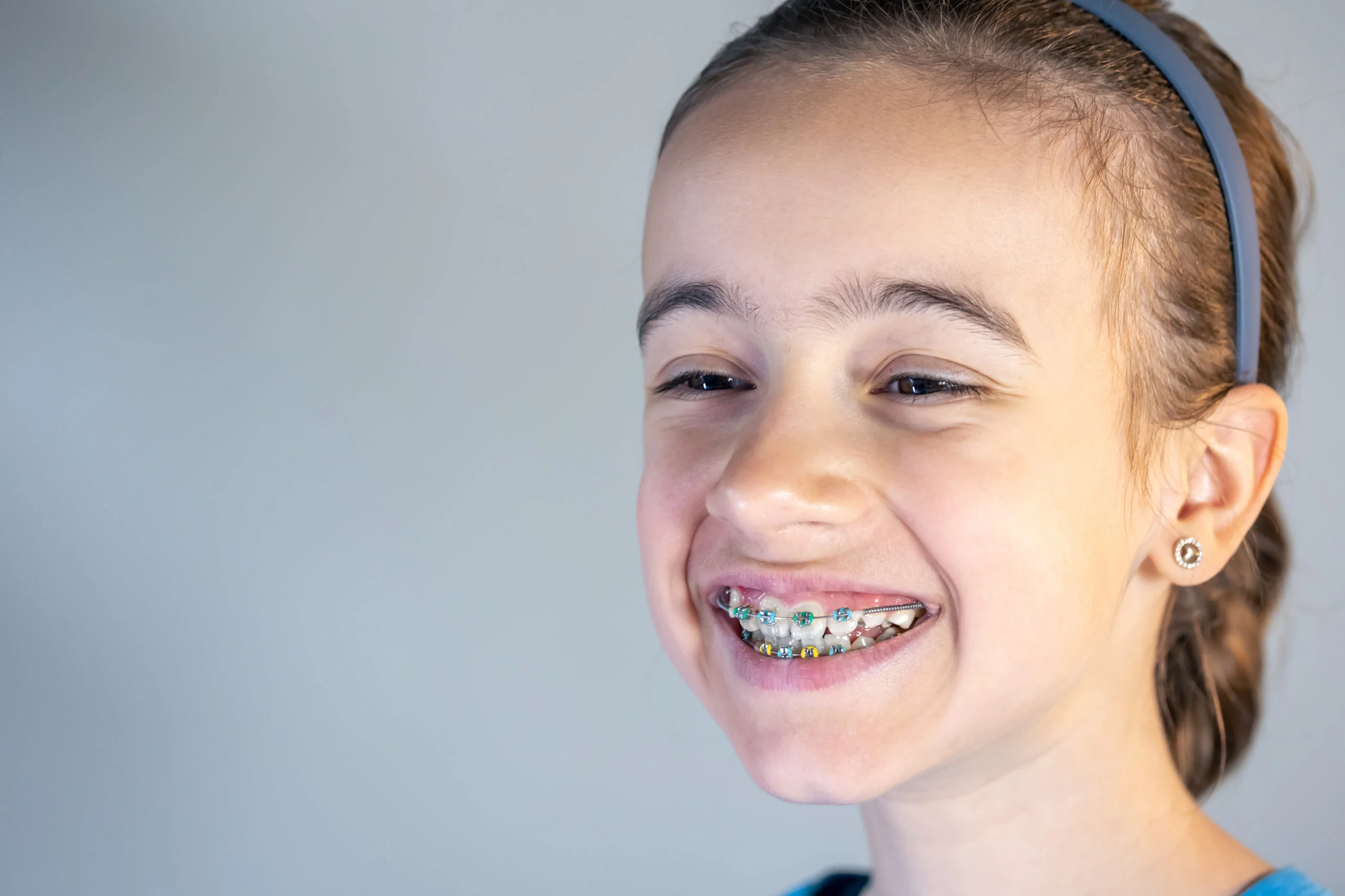 You are currently viewing Invisible Braces in Bangalore – The Best Choice for a Confident Smile