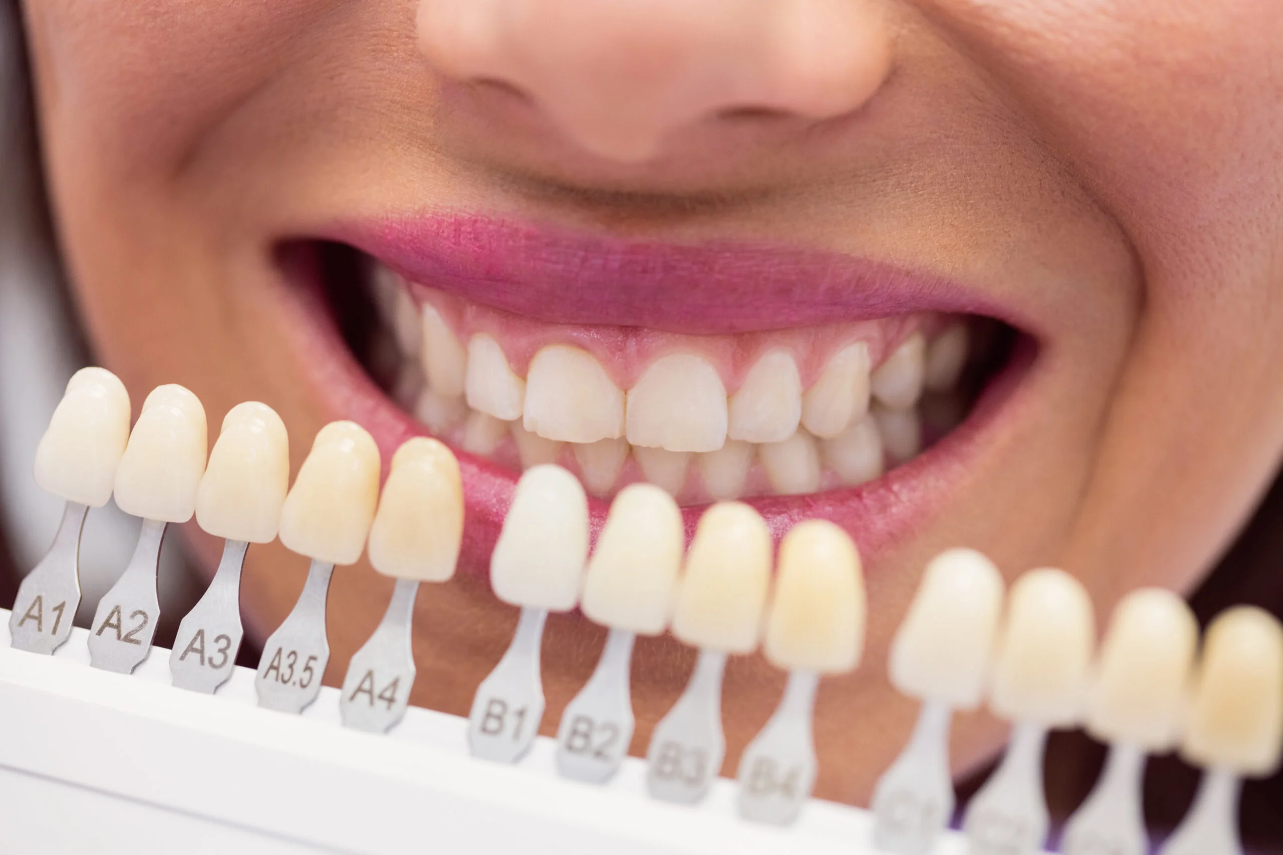 You are currently viewing Best Veneers in India: What You Need to Know Before Getting a Smile Makeover